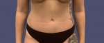 Abdominoplasty (Tummy Tuck) 19 After